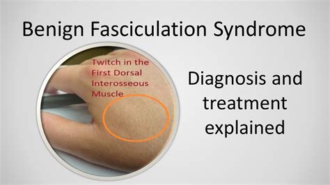 <b>Benign</b> <b>fasciculation</b> <b>syndrome</b> is thought to be due to overactivity of the nerves associated with the twitching muscle. . Benign fasciculation syndrome support group